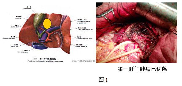 肝門腫瘤的外科治療