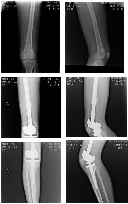 右側股骨下端骨腫瘤,行右股骨下端骨肉瘤瘤段切除,人工假體置換術